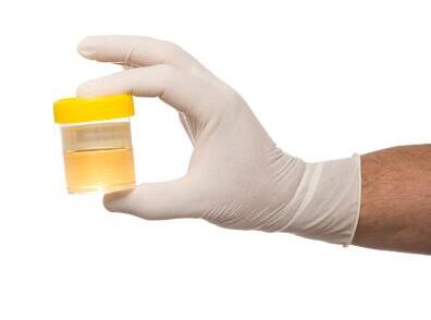 Sci Adv：突破！科学家仅利用1毫升尿液就能诊断出多种类型癌症！