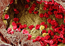 PD-1抑制剂Nivolumab免疫治疗过程中的肿瘤及微环境进化研究