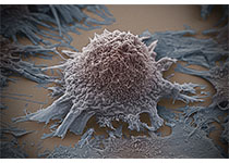 研究人员发现多个三阴性乳腺癌高危基因